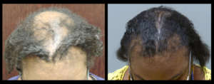 Hair Restoration Before and After - Hair Loss Solutions