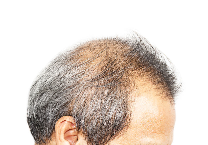 Dihydrotestosterone DHT Can Cause Baldness But What Is It  Mens Health