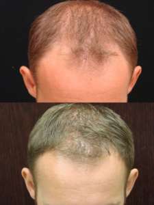 Various Hair Transplant Uses. WHY NEOGRAFT HAIR TRANSPLANT