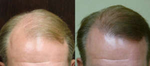 2,500 grafts 1 ½ yr after Hair Restoration