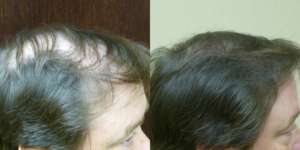 46 year old, 2,379 grafts, one year after Hair Restoration