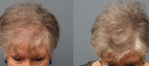 Hair Transplant with strip excision, 69 year old, 1,500 grafts, Before and 11 months after