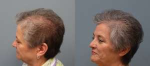 Hair transplant with strip excision 66 year old 1,325 Grafts Before and 11 months after