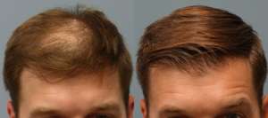 Neograft Hair Transplant Results Before and After 1500 grafts (5 months)