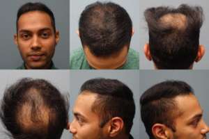 Before Neograft Hair Restoration