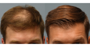 WHY NEOGRAFT HAIR TRANSPLANT_ Hair Loss Solution in Savannah Georgia by Hair Restoration Savannah by Dr Finger (3)