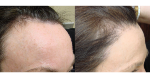 Before and After Results at Hair Restoration Savannah