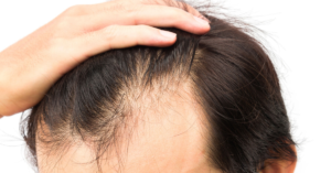 Are You Looking For A Hair Loss Product?Spectral.DNC-N® topical spray is offered at Hair Restoration Savannah