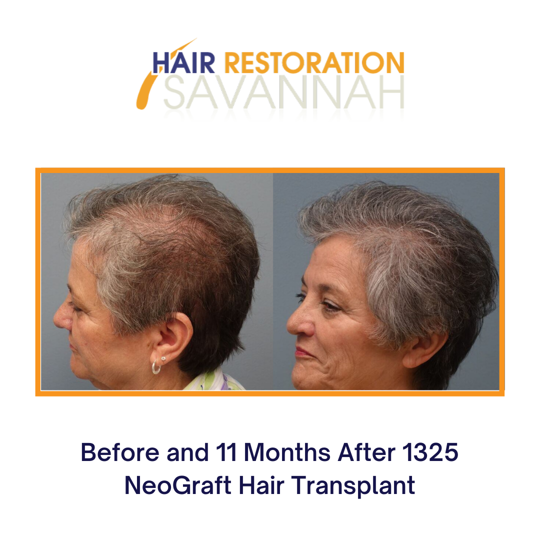 Neograft before and after - fight female hair loss with PRP and Hair Transplantation