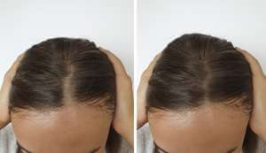 Women Neograft Hair Transplant Results at Hair Restoration Savannah.