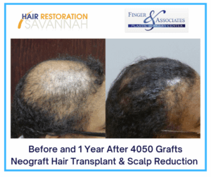 Before and 1 Year After 4050 Grafts Neograft Hair Transplant & Scalp Reduction