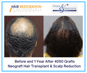 Before and 1 Year After 4050 Grafts Neograft Hair Transplant & Scalp Reduction