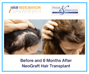 Before and 6 Months After NeoGraft Hair Transplant