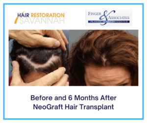 Before and 6 months after NeoGraft hair transplant Savannah GA
