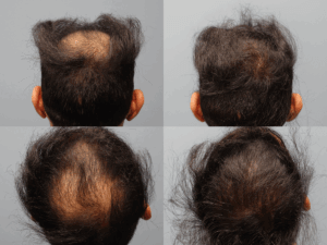 Patient before and after NeoGraft hair restoration Savannah