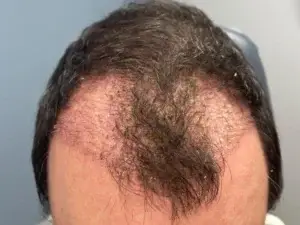 NeoGraft Results at 17 Days 2,500 Grafts Taking Root at Hair Restoration Savannah, GA