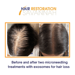 Before and after two microneedling treatments with exosomes for hair loss (final result 8-months after 1st treatment)