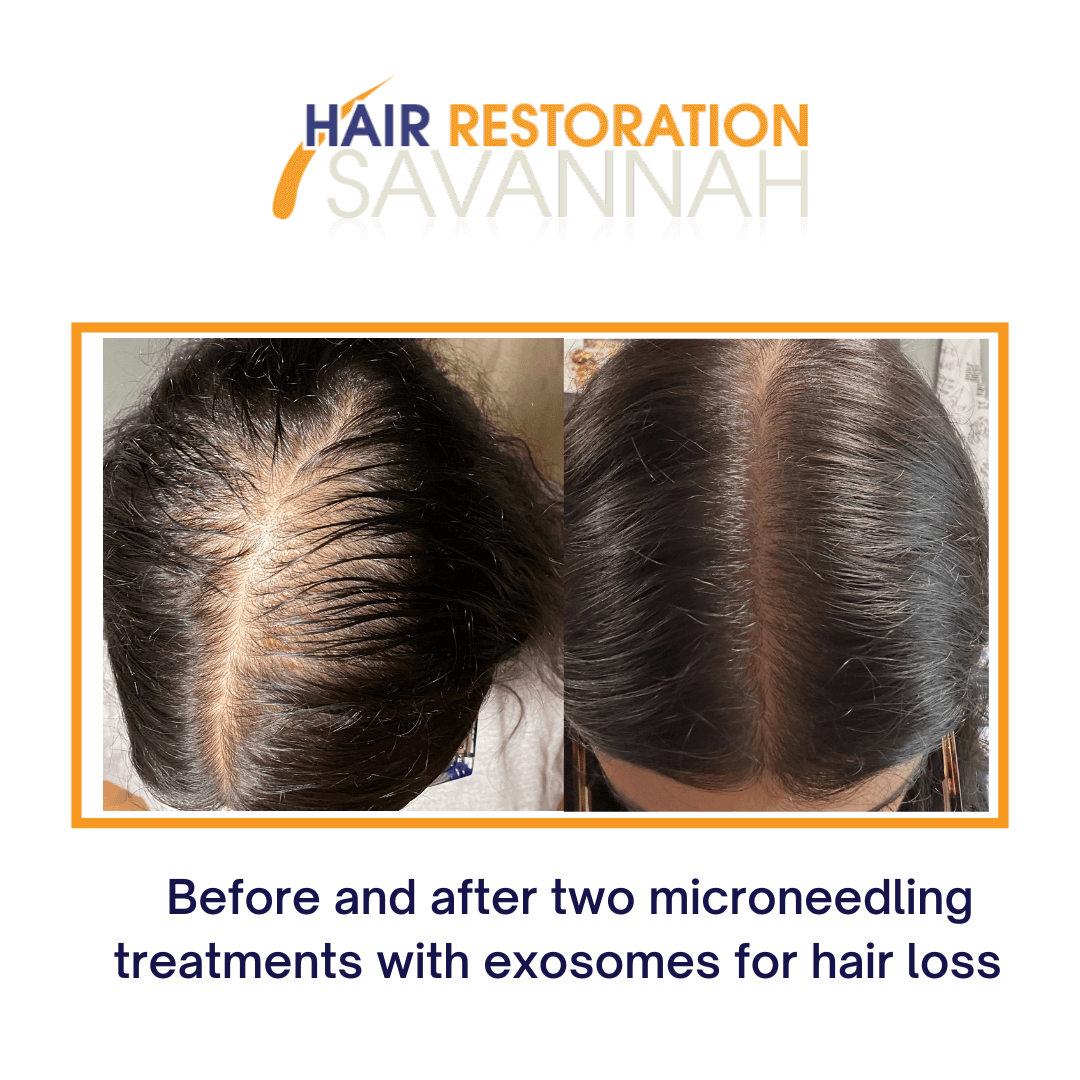 Before and after two microneedling treatments with exosomes for hair loss (final result 8-months after 1st treatment)