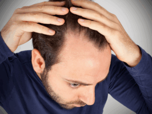 Hair Thinning in men - Hair Restoration Savannah can help