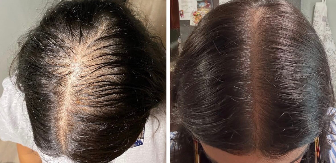 Before and after two microneedling treatments with exosomes for hair loss (final result 8-months after 1st treatment)