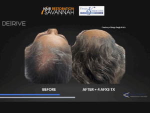 Before and After DE|RIVE Hair Restoration
