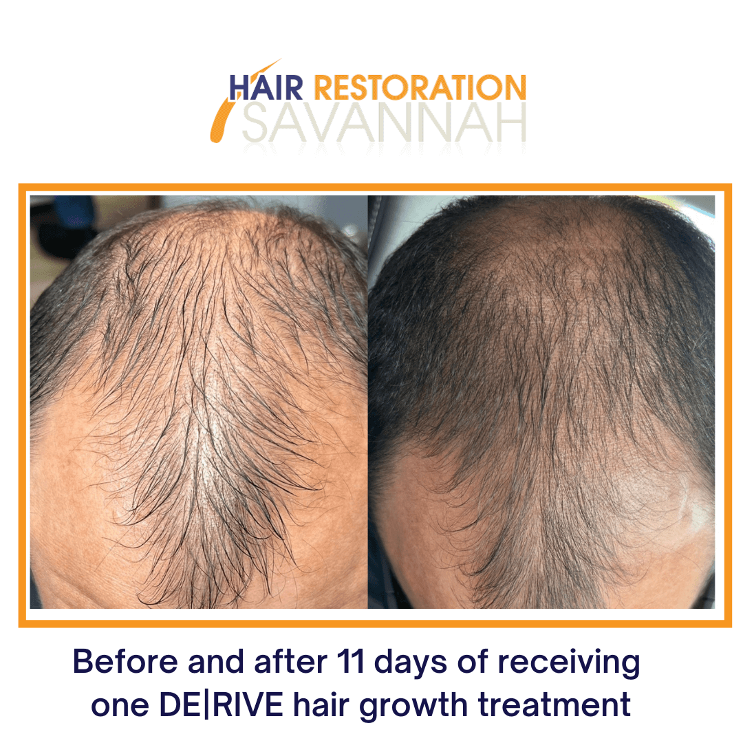Before and after 11 days of receiving one DERIVE hair growth treatment Before and after 11 days of receiving one DERIVE hair growth treatment