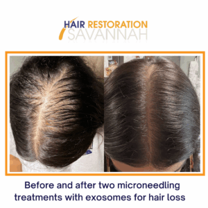 Before and after two microneedling treatments with exosomes for hair loss (final result 8-months after 1st treatment)