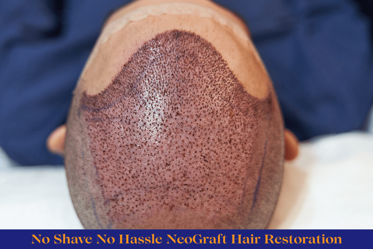 Neograft Hair Restoration in Savannah,GA