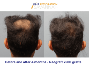 Before and after 4 Months of Neograft Results in Savannah, GA