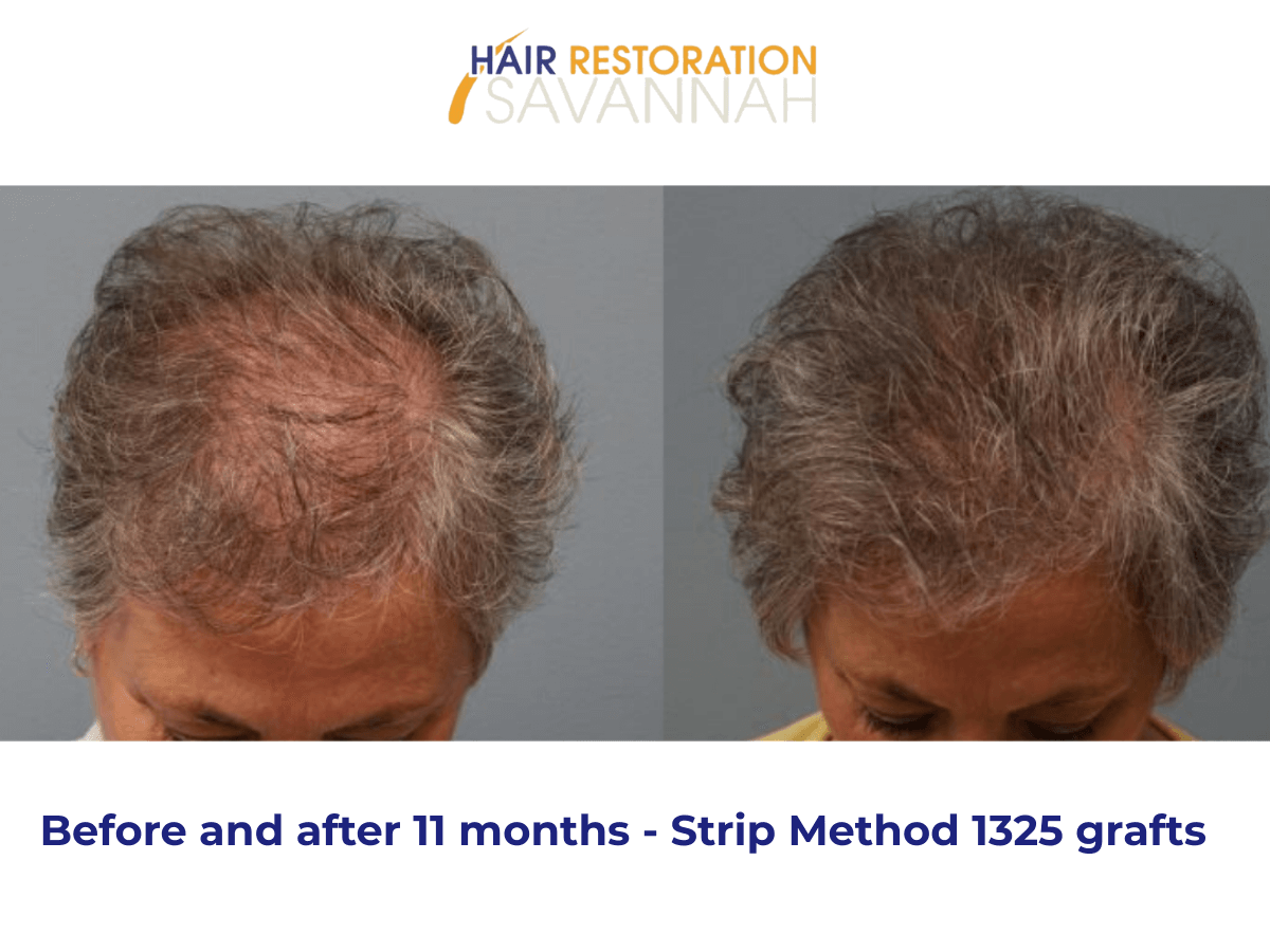 Strip Method FUT Hair Transplantation Results in Savannah, GA