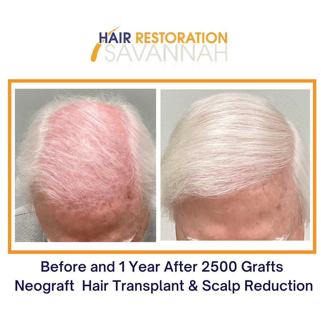 Before and 1 Year After 2500 Grafts Neograft Hair Transplant & Scalp Reduction