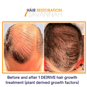 Before and after 1 DERIVE hair growth treatment (plant derived growth factors)